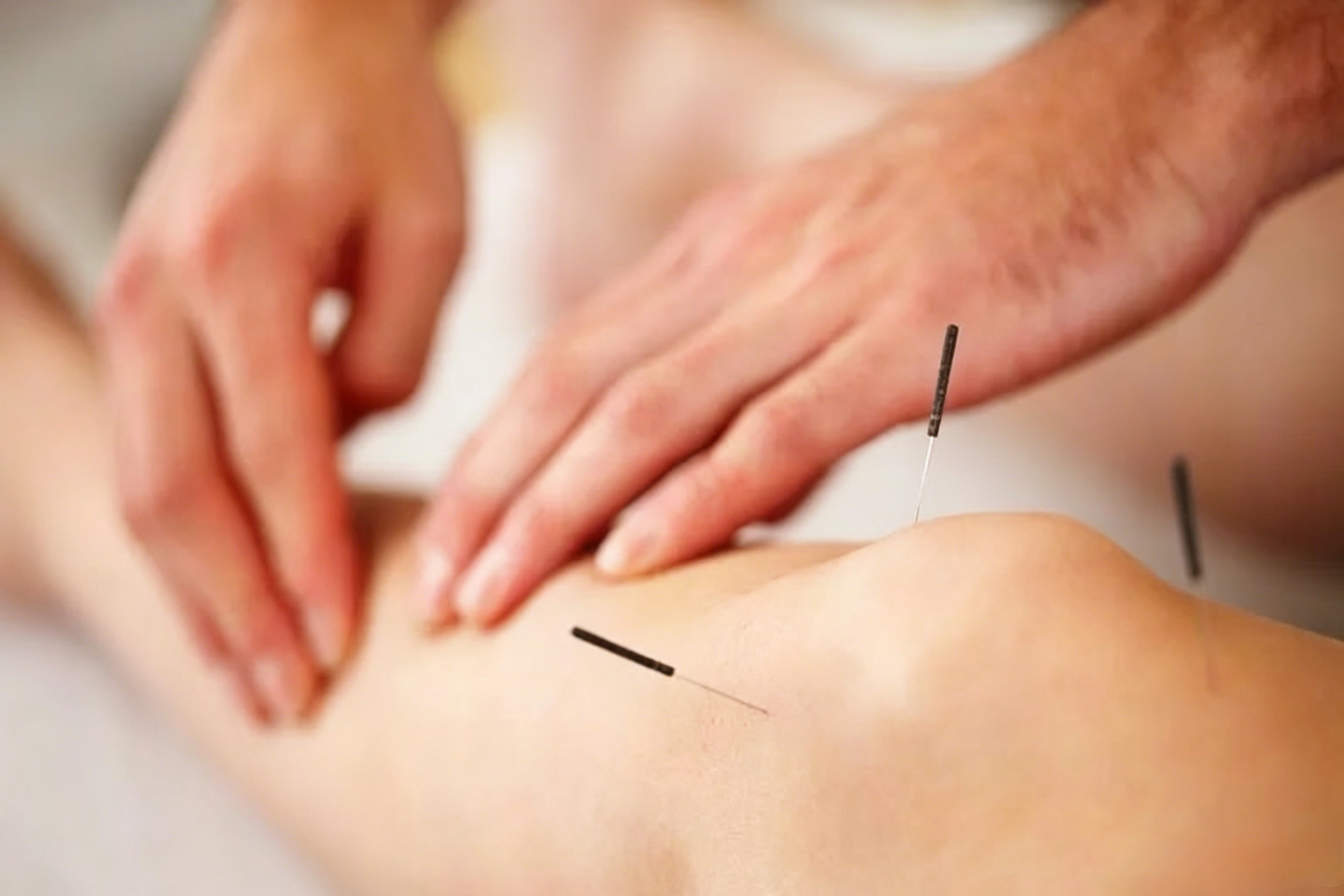 Acupuncture treatment with fine needles inserted along the back meridian points